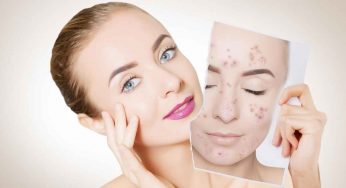 Get Rid of Acne – Permanently, Easily, Naturally